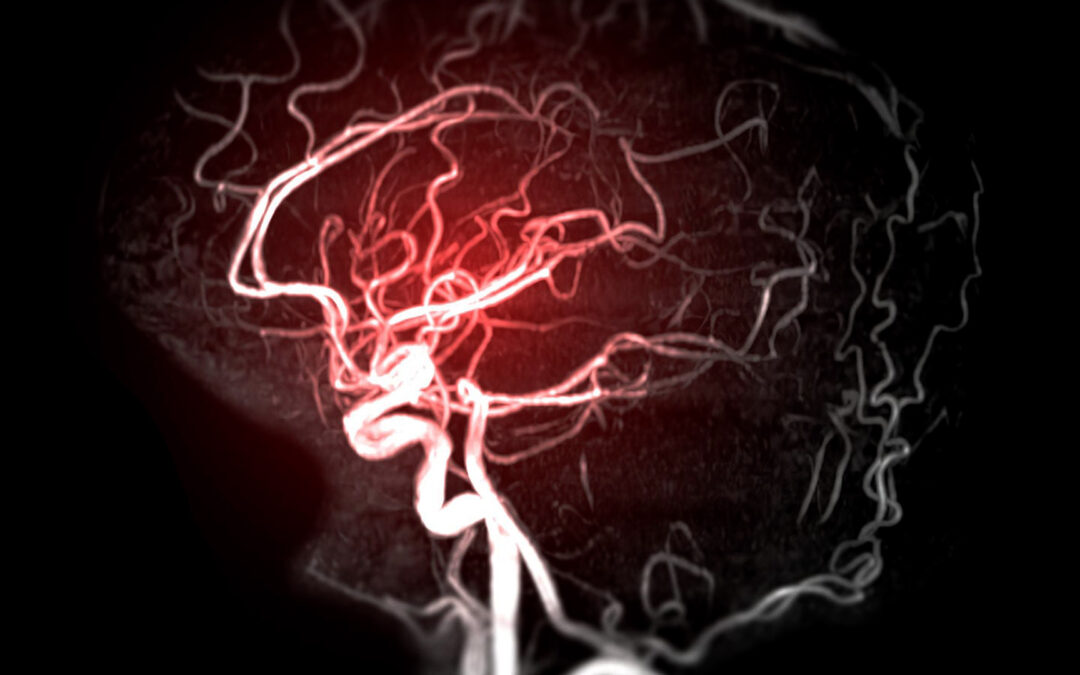 Brain Aneurysms Explained: Symptoms, Diagnosis, and Treatment Options