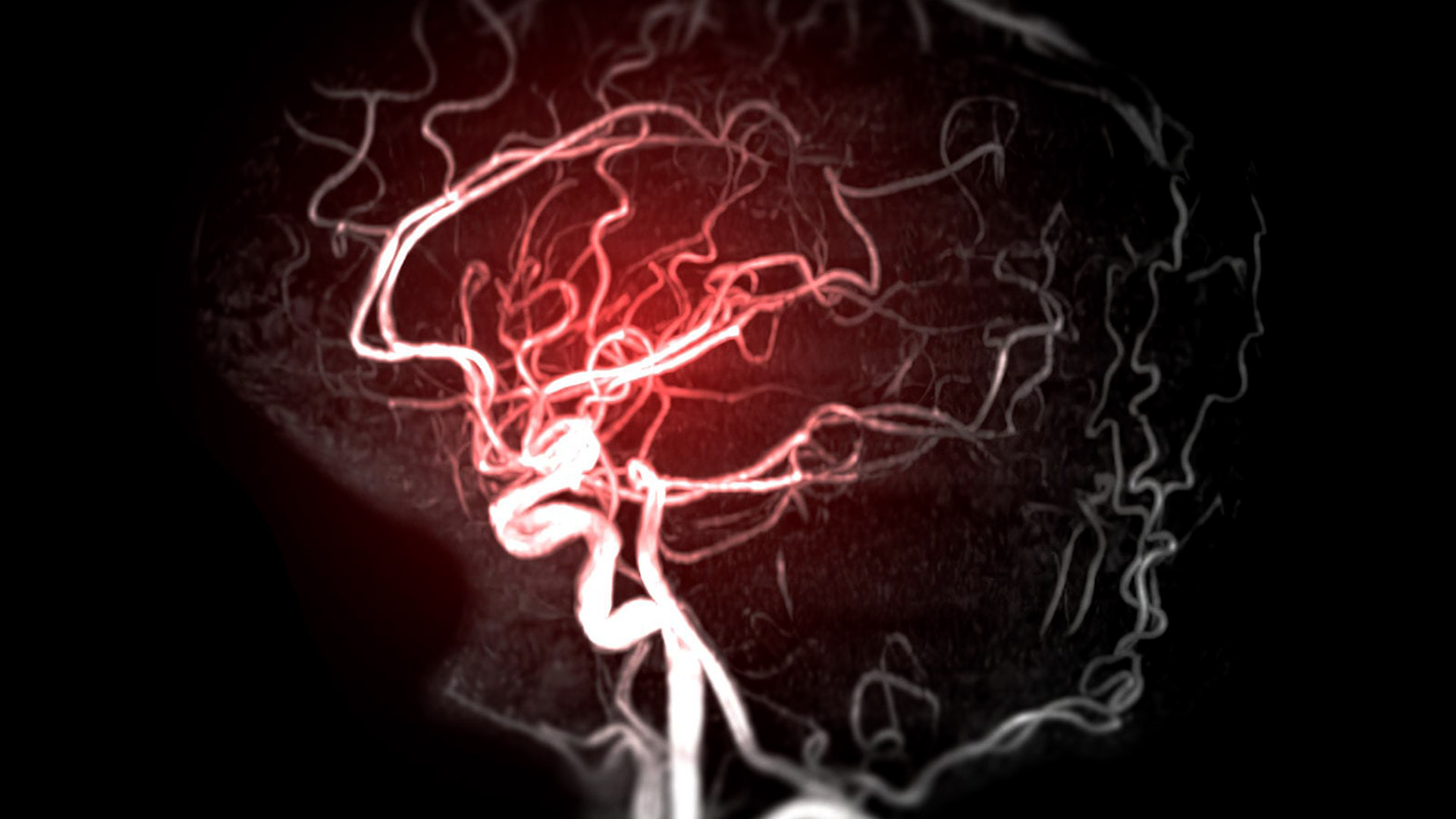 Understand the signs and treatment options of Brain Aneurysms