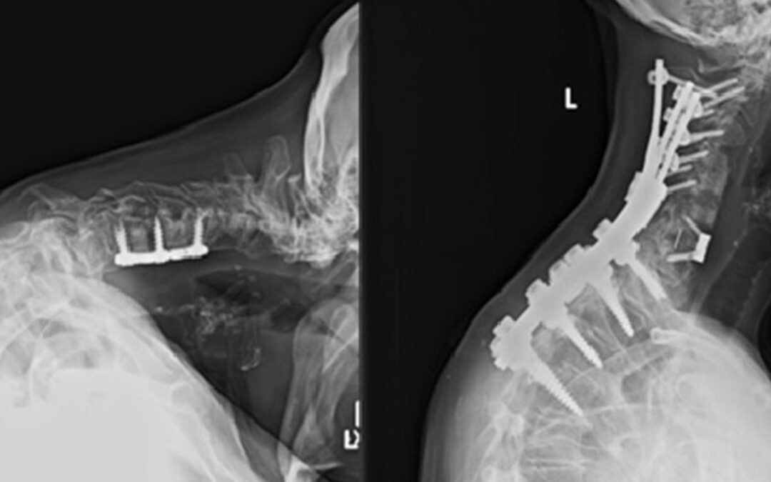 Cervical Deformity: Causes, Symptoms, and Surgical Correction