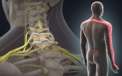 Cervical Radiculopathy: Understanding Nerve Pain in the Neck and Arms
