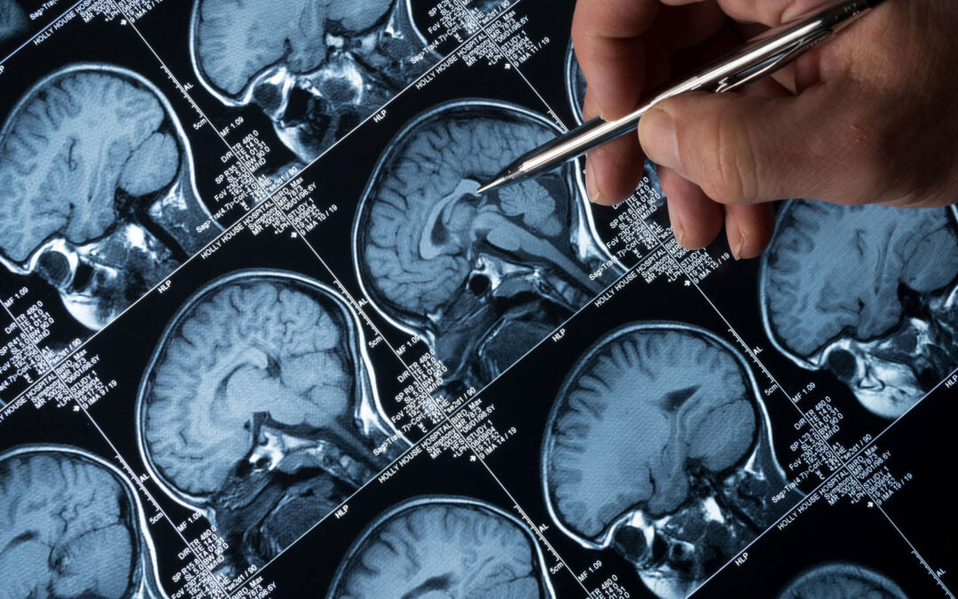 Understanding Glioma: Insights into a Complex Brain Tumor