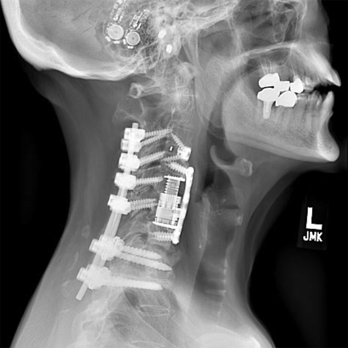 cs-cervical-deformity-72-after Cervical Deformity