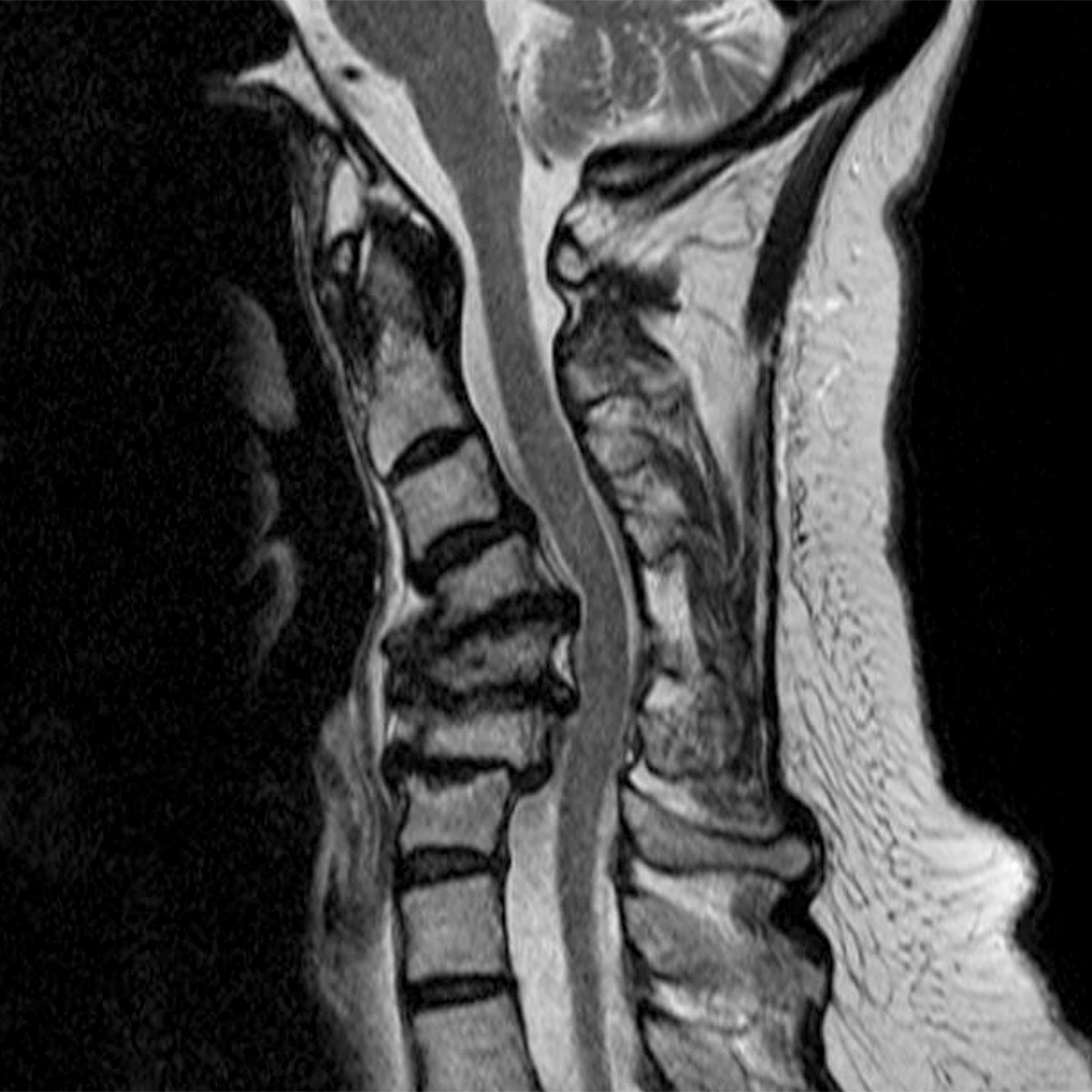 cs-cervical-deformity-72-before Cervical Deformity
