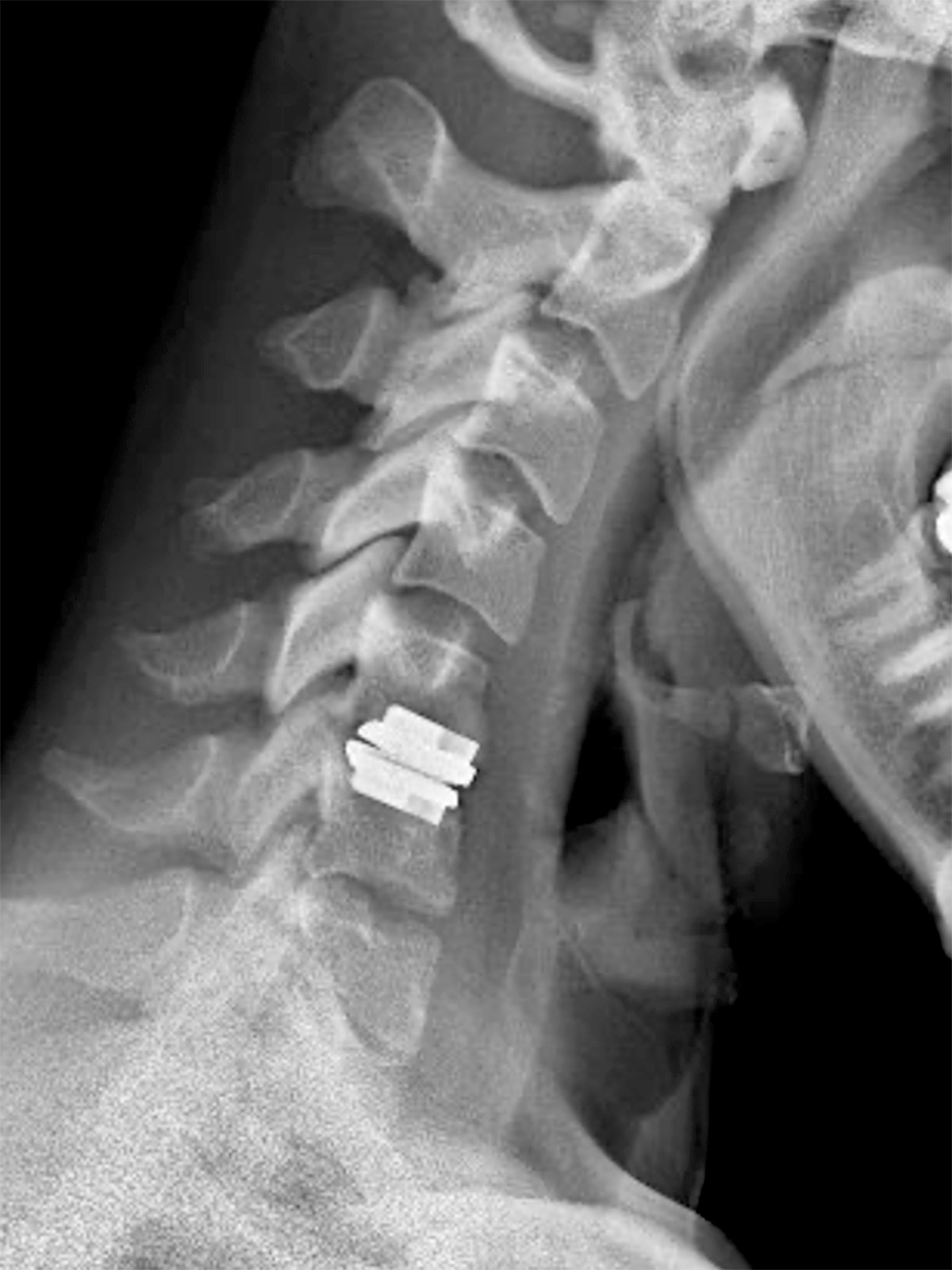 cs-cervical-myelopathy-34-after Cervical Myelopathy