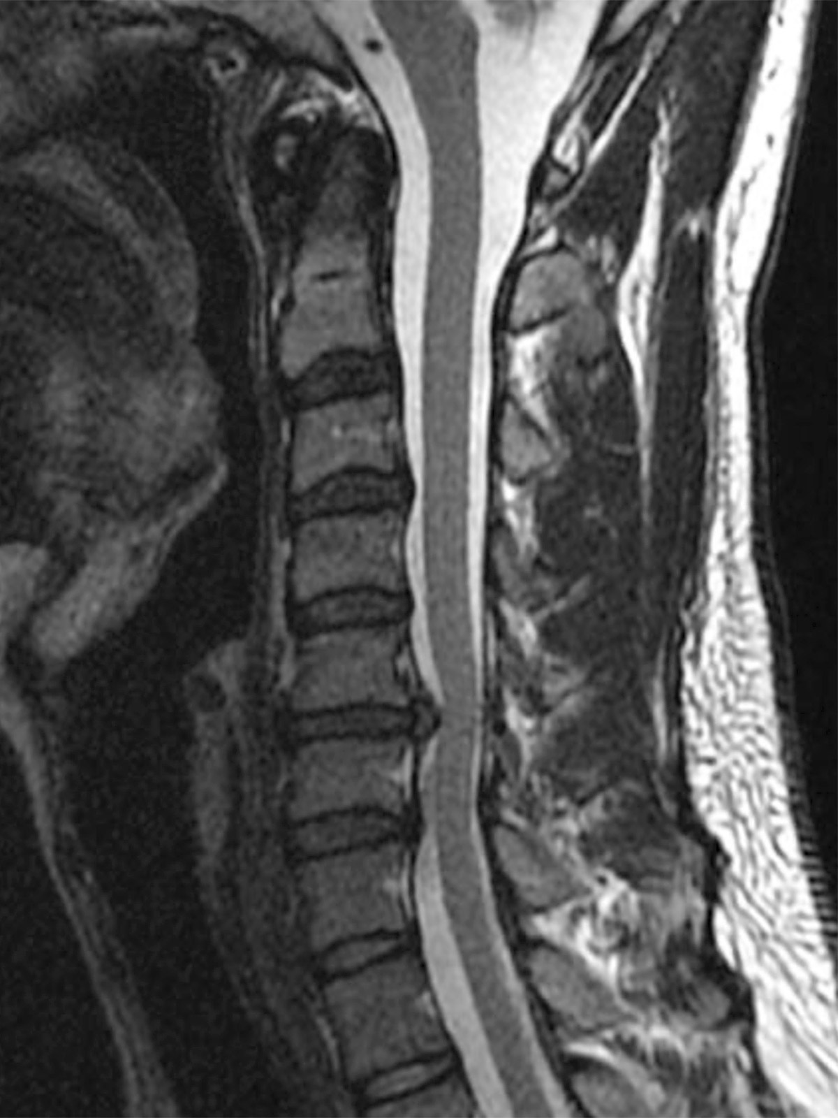 cs-cervical-myelopathy-34-before Cervical Myelopathy