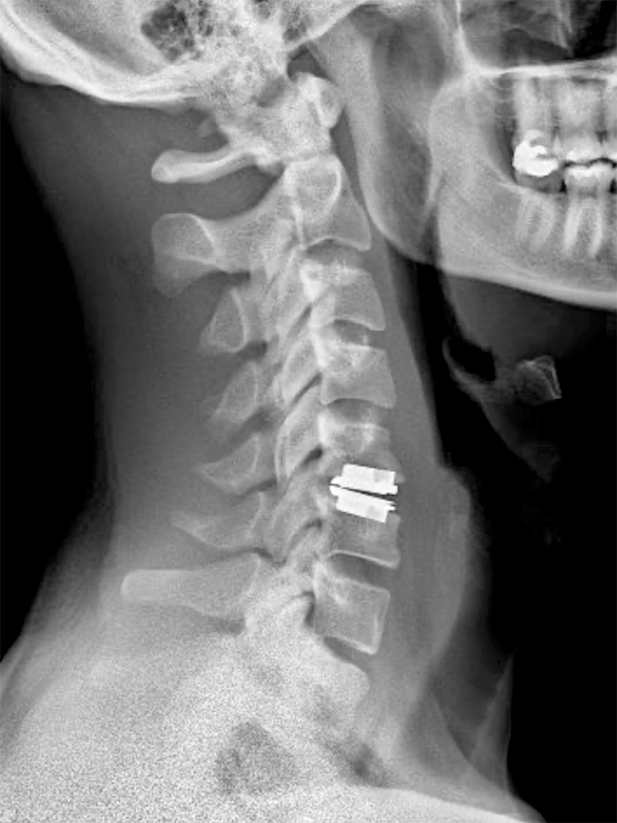 cs-cervical-myelopathy-34-motion Cervical Myelopathy
