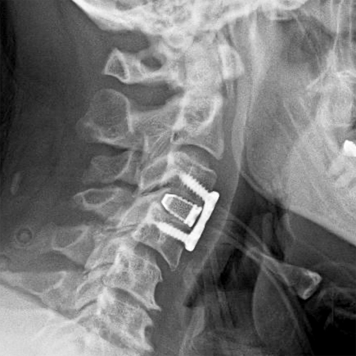 cs-cervical-myelopathy-72-after Cervical Myelopathy