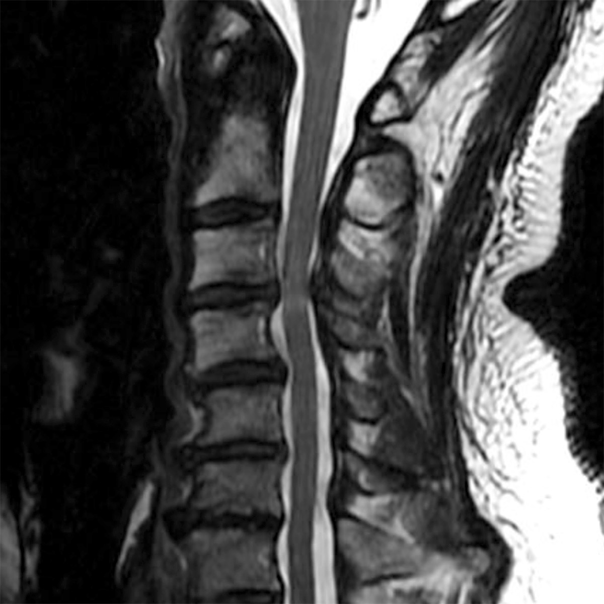 cs-cervical-myelopathy-72-before Cervical Myelopathy