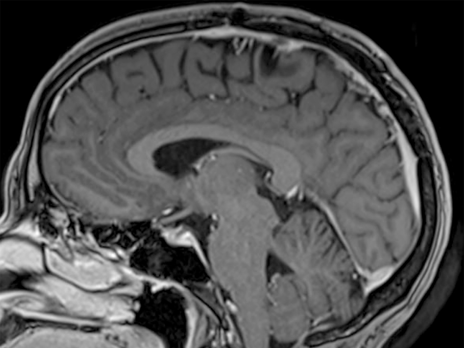 Meningioma