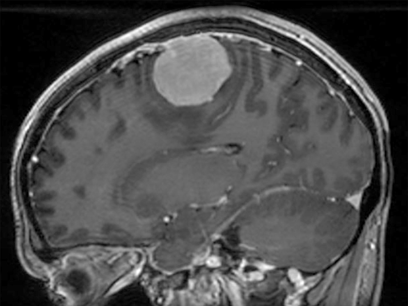 Meningioma