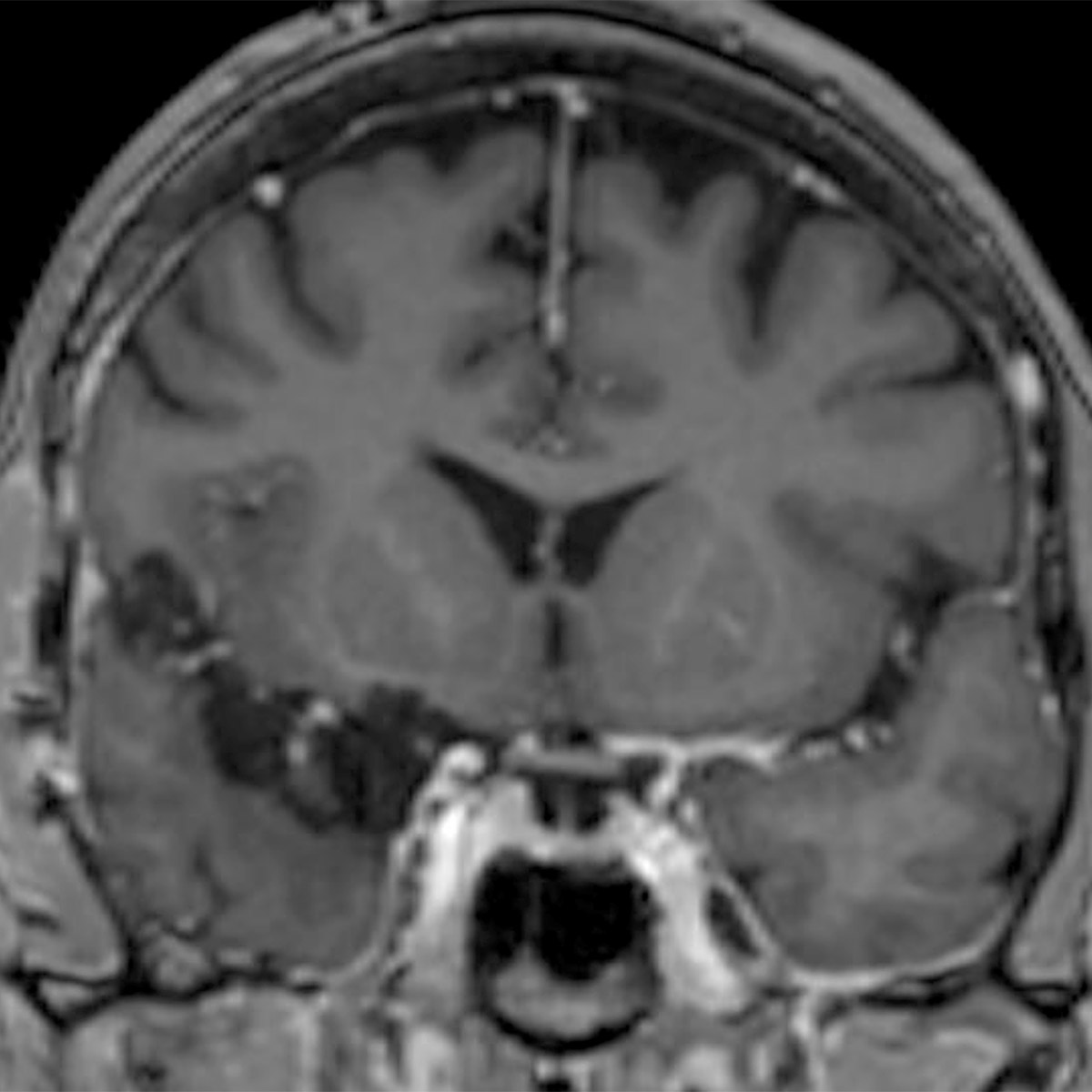 Meningioma