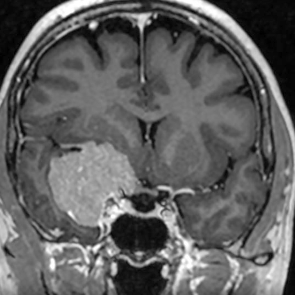 Meningioma