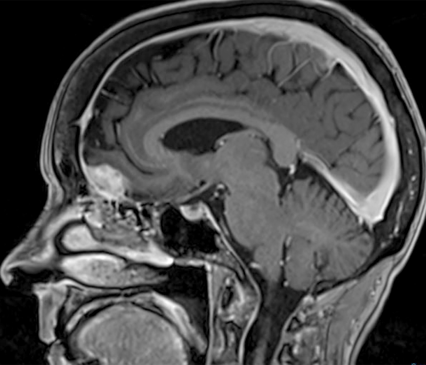Meningioma