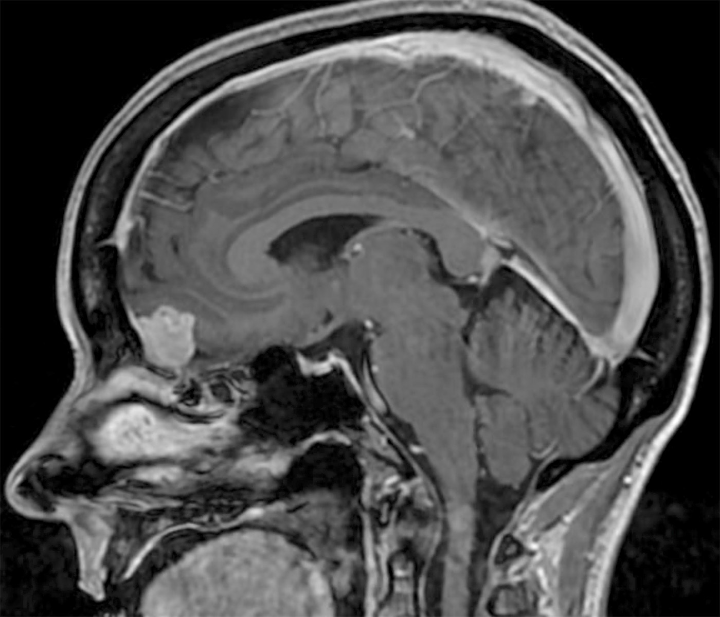 Meningioma